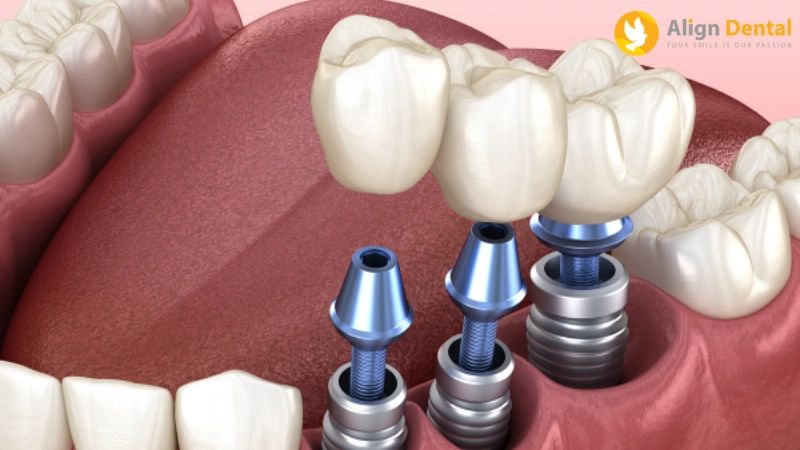 nhược điểm của trồng răng implant