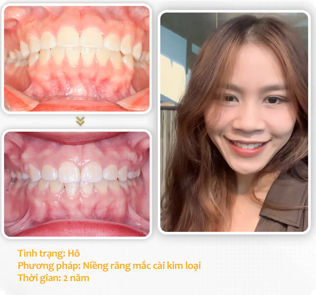 aligndental