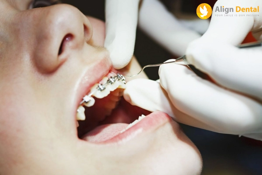 Niềng Răng Bao Nhiêu Tiền? Các Yếu Tố Ảnh Hưởng Đến Giá