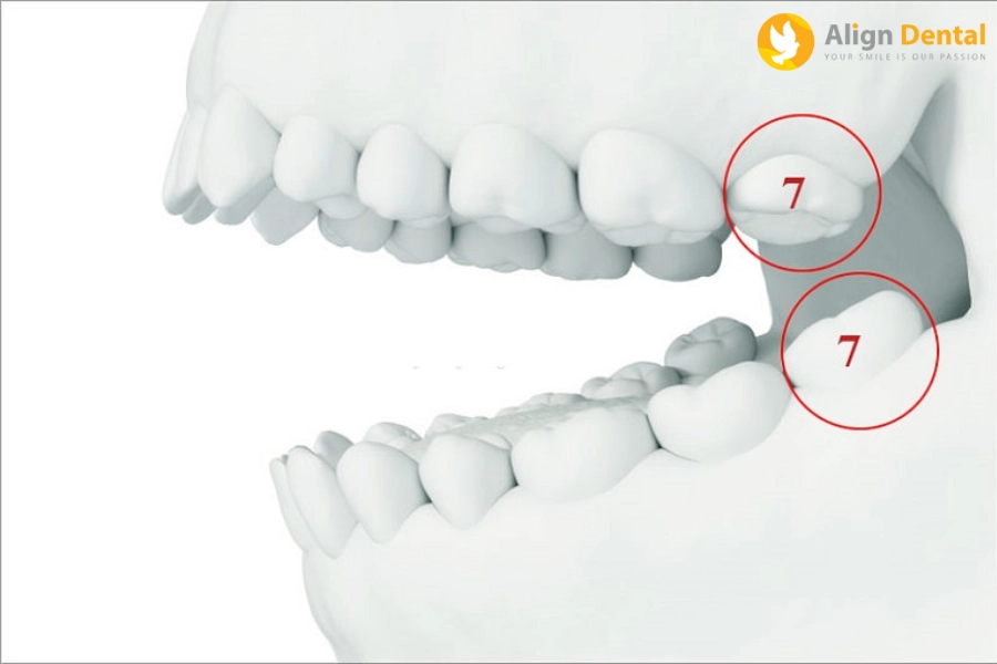 #Trồng Răng Số 7 Hàm Dưới Bao Nhiêu Tiền? Chi Phí Phụ Thuộc Yếu Tố Nào?