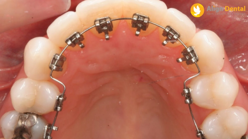 các loại niềng răng
