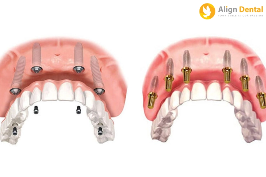 Trồng Implant Toàn Hàm Bằng Kỹ Thuật All on 4, All on 6