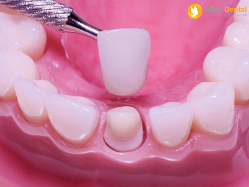 răng sứ thẩm mỹ