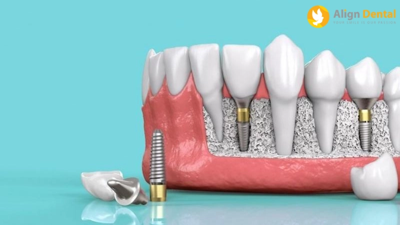 nhược điểm của trồng răng implant