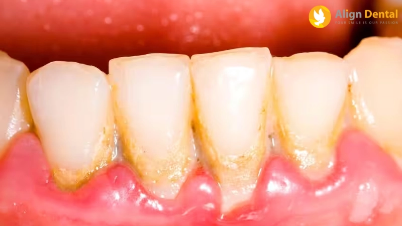 viêm quanh implant