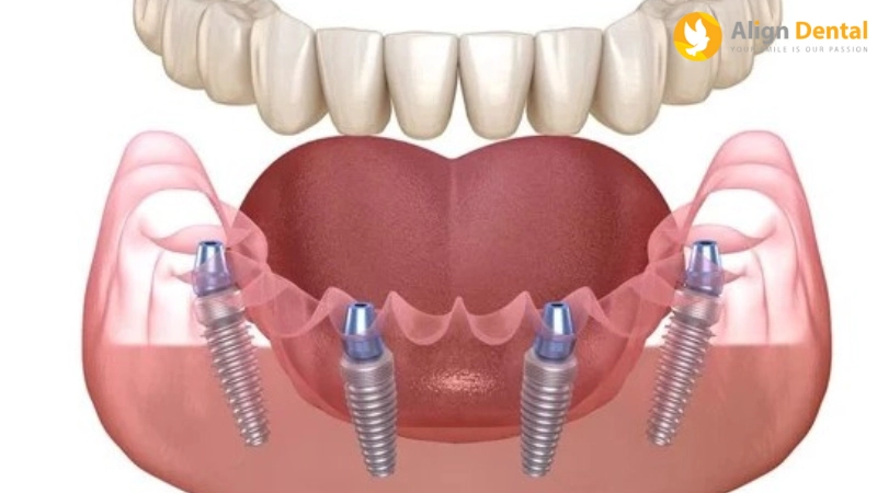 implant toàn hàm