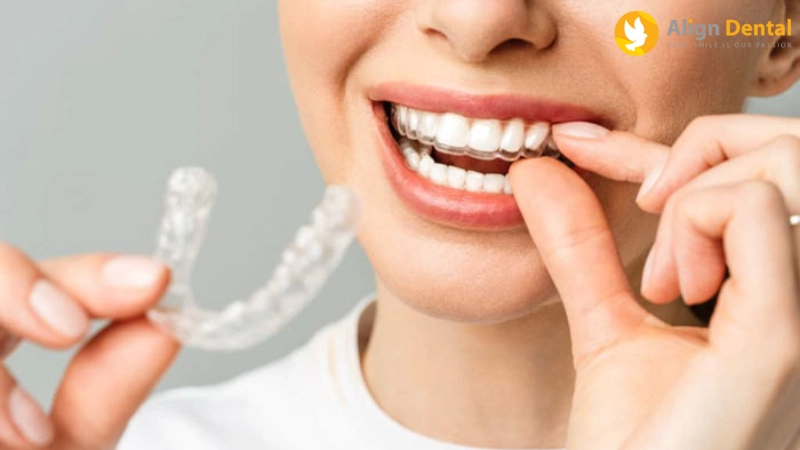 niềng răng bị hóp má