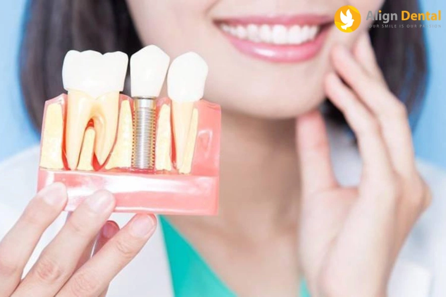 [Giải Đáp] Trồng Răng Implant Bao Lâu Thì Ăn Được?