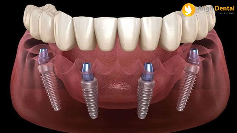trồng răng implant
