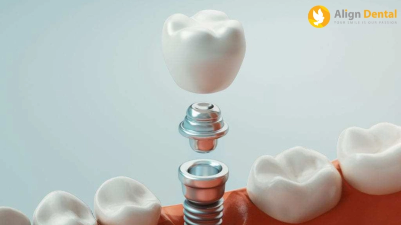 Chụp sứ trên Implant
