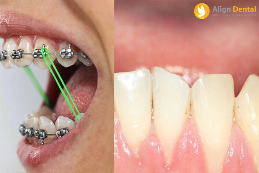 Tụt Lợi Khi Niềng Răng Là Gì? Cách Khắc Phục Ra Sao?