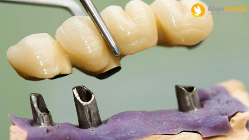 viêm quanh implant