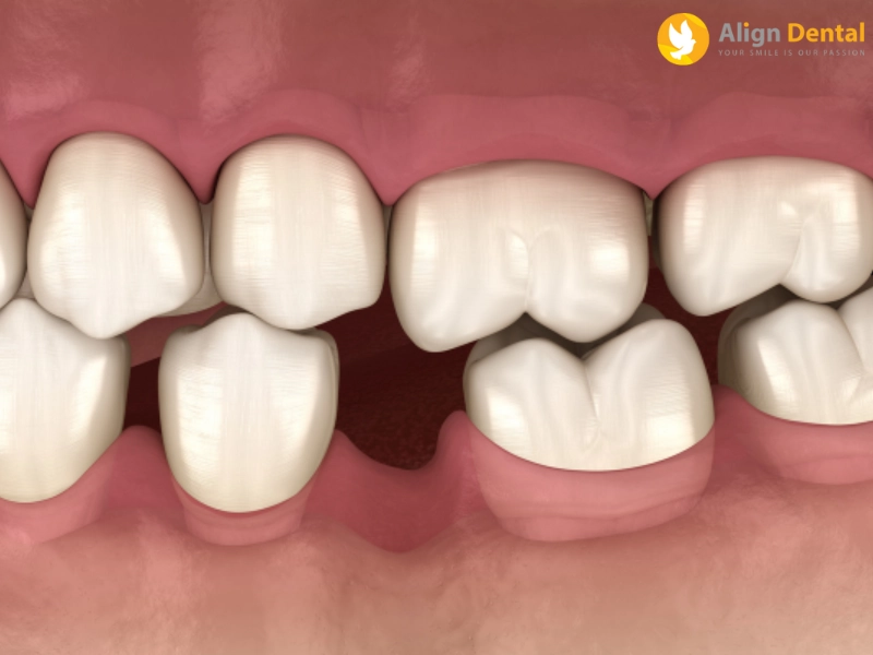 Trồng răng hàm số 6 giá bao nhiêu tiền
