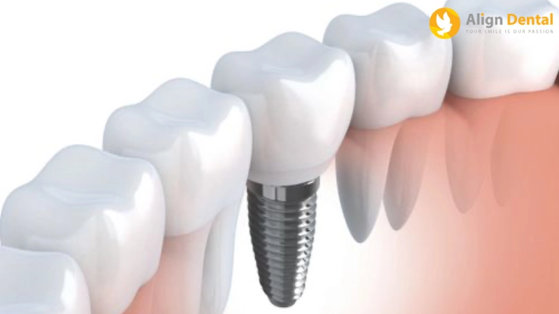 nhược điểm của trồng răng implant