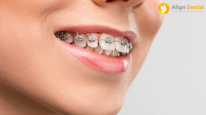 dấu hiệu niềng răng hỏng