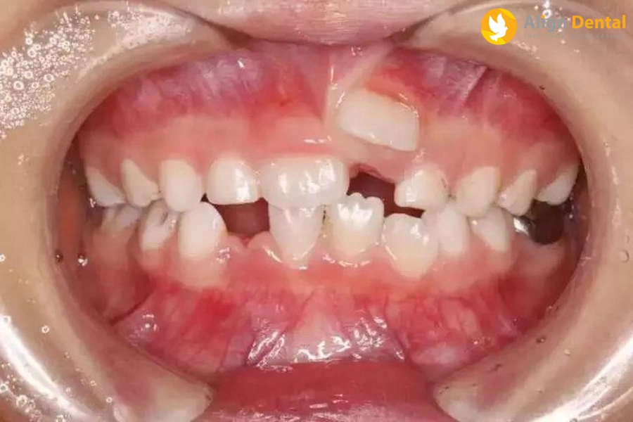 Răng Mọc Lẫy Là Gì? Tác Hại Của Răng Mọc Lẫy Ra Sao?