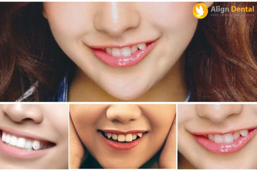 Có Nên Niềng Răng Khểnh Không? Thời Gian Niềng Mất Bao Lâu?