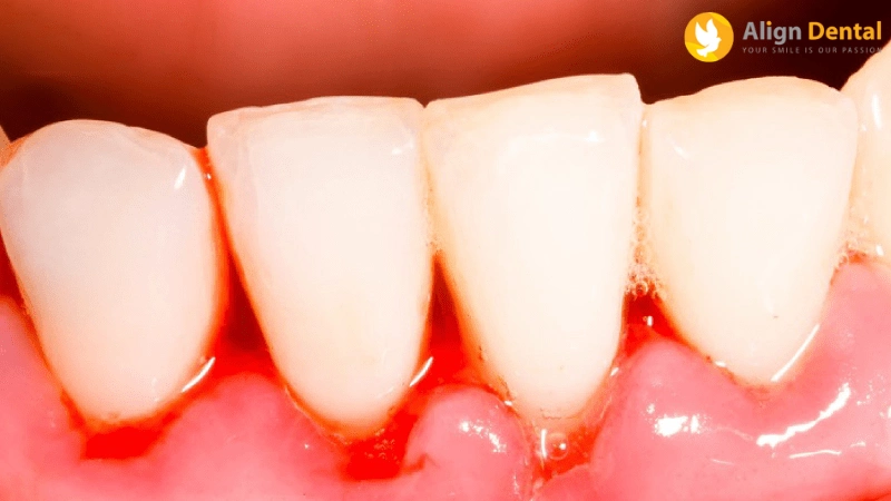 viêm quanh implant
