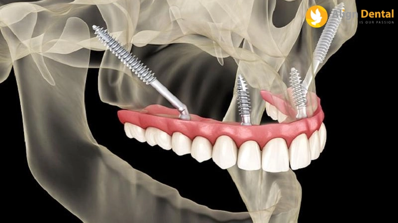 cấy ghép implant xương gò má