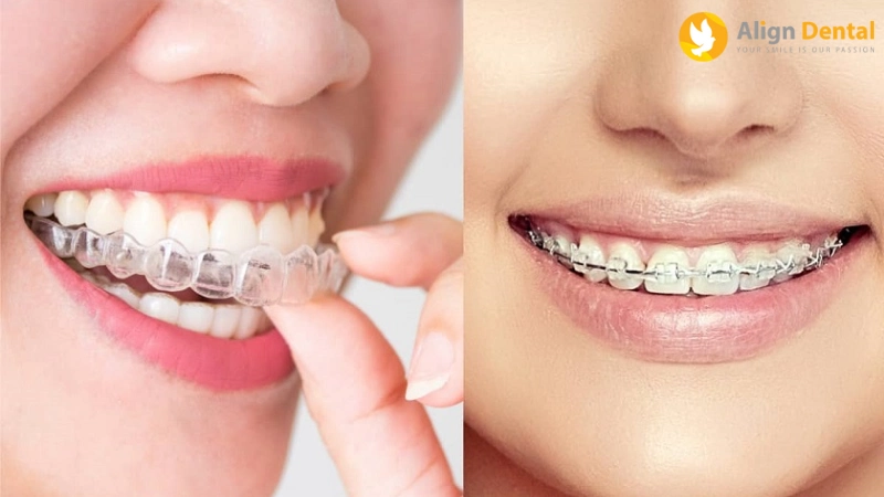 các loại niềng răng