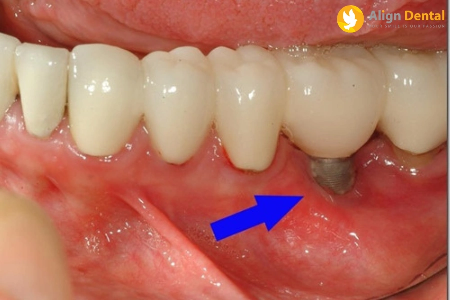 Nguyên Nhân Bị Viêm Quanh Implant Và Cách Điều Trị