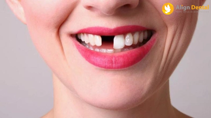 nhổ răng bao lâu thì trồng lại được