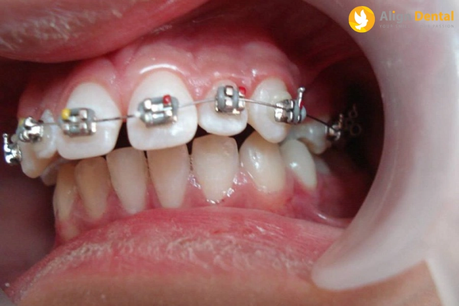 Niềng Răng Vẩu Mất Bao Lâu? Quy Trình Niềng Răng Vẩu Tại Align Dental