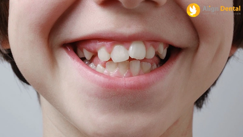 niềng răng trẻ em