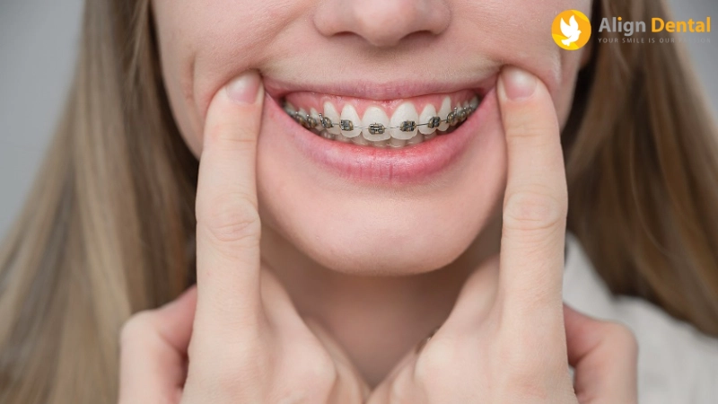 dấu hiệu niềng răng hỏng