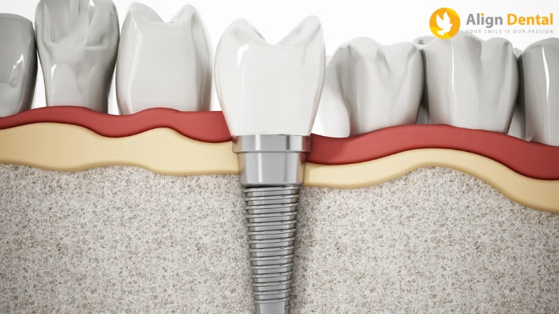 trồng răng implant