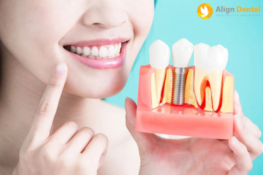[Giải Đáp] Sau Khi Nhổ Răng Bao Lâu Thì Trồng Implant?