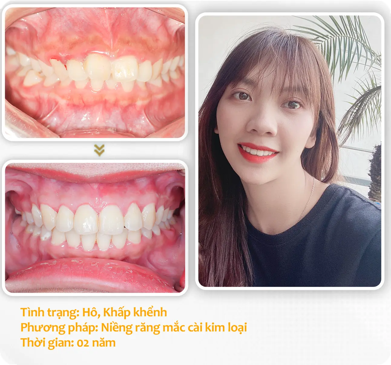 aligndental