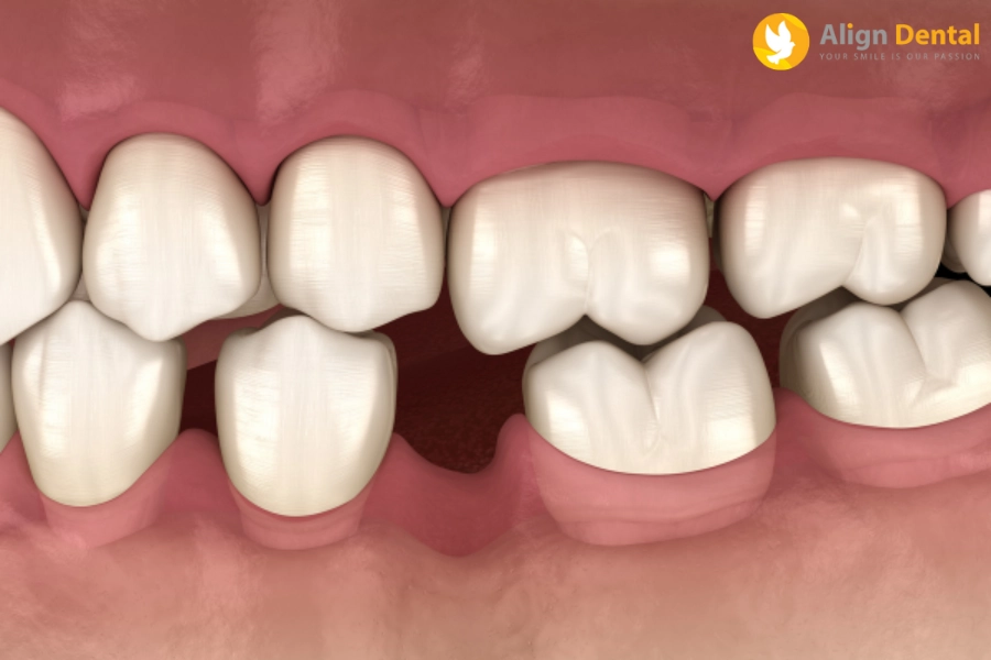 #Trồng Răng Hàm Số 6 Giá Bao Nhiêu Tiền? Cập Nhật Mới Nhất 2024