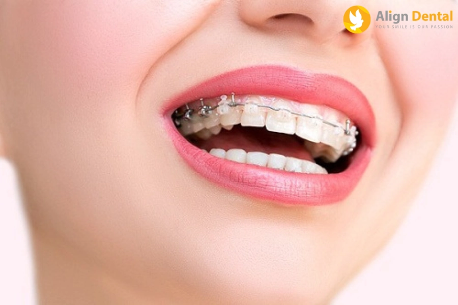 Niềng Răng Là Gì? Lợi Ích Tuyệt Vời Của Niềng Răng Mang Lại