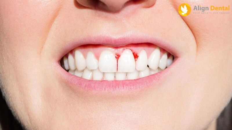 Điều trị viêm lợi