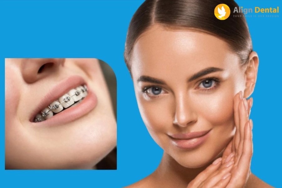 [Hỏi - Đáp] Gò Má Cao Có Nên Niềng Răng Hay Không?