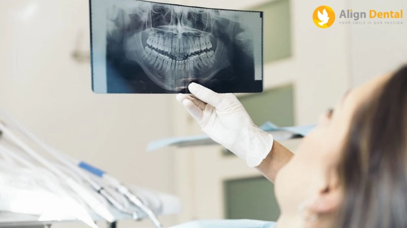 implant toàn hàm