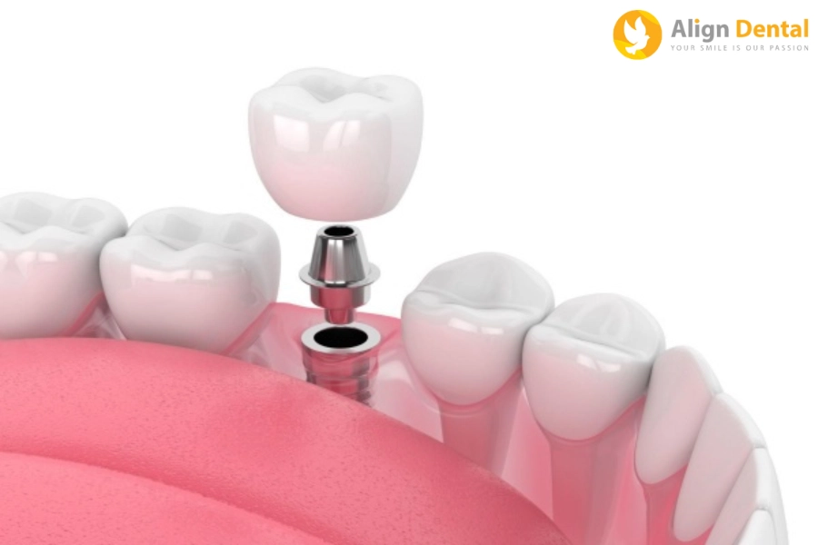 Tìm Hiểu Ưu, Nhược Điểm Của Trồng Răng Implant 