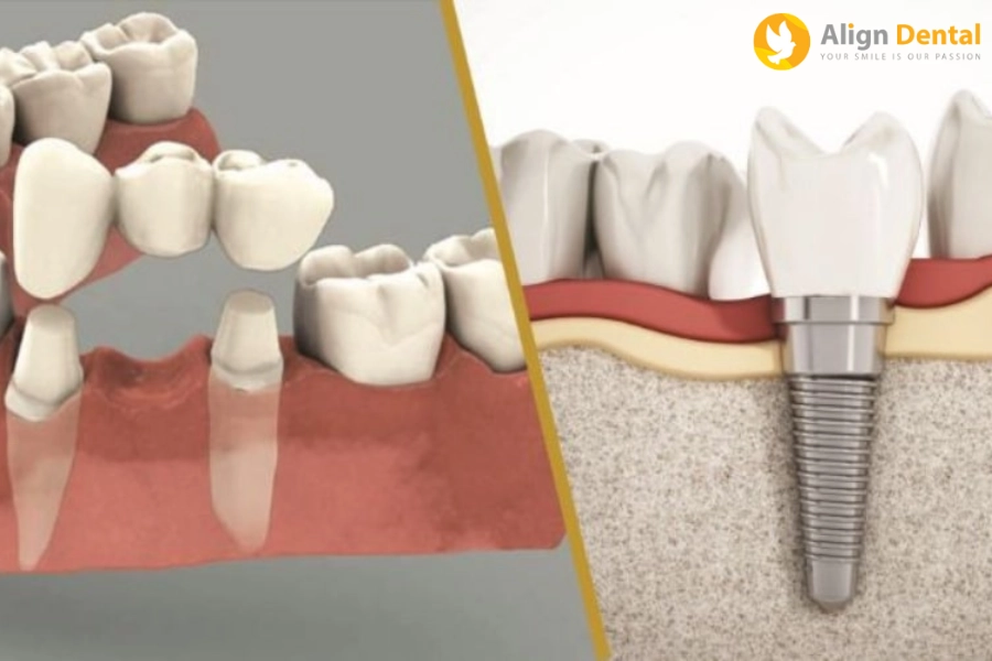 Trồng Răng Vĩnh Viễn - Phương Pháp Nào Tốt Nhất Cho Bạn