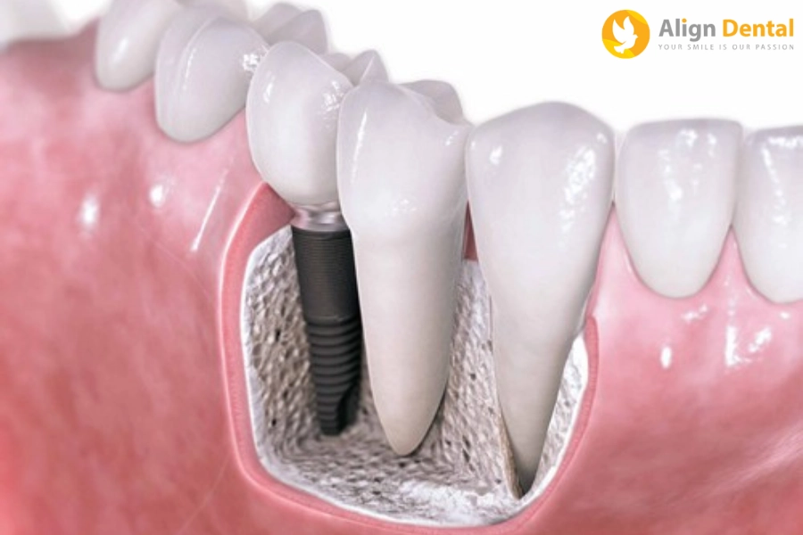 Hối Hận Khi Trồng Implant Quá Trễ Và Những Tác Hại Khôn Lường