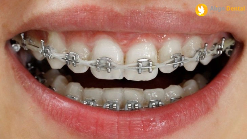 niềng răng mắc cài kim loại