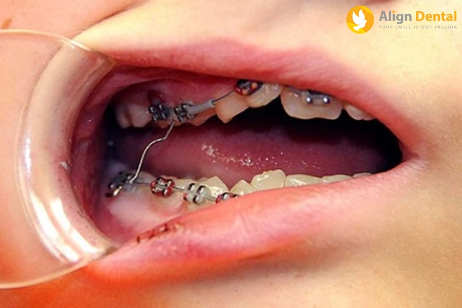 Dấu Hiệu Niềng Răng Hỏng Và Hướng Khắc Phục Tình Trạng Răng