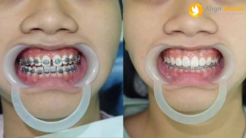 niềng răng bị hóp má