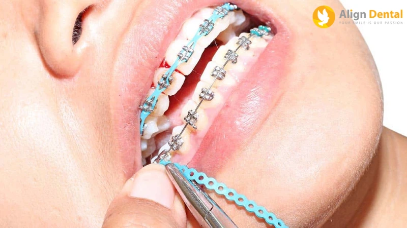 quá trình niềng răng