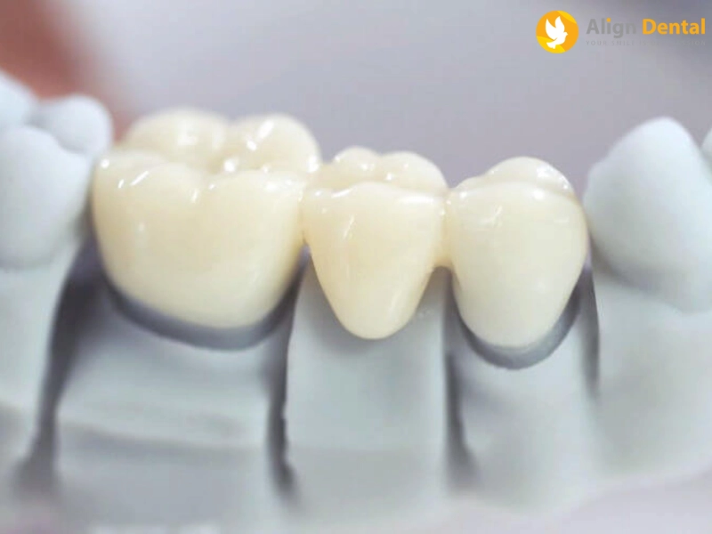 răng sứ thẩm mỹ
