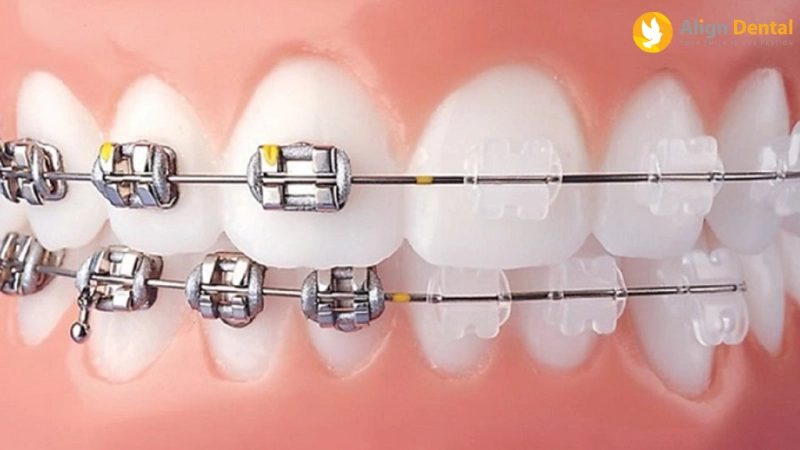 Niềng răng mắc cài kim loại