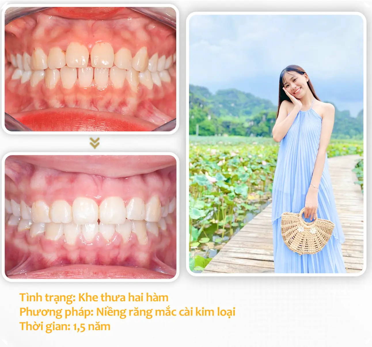 aligndental