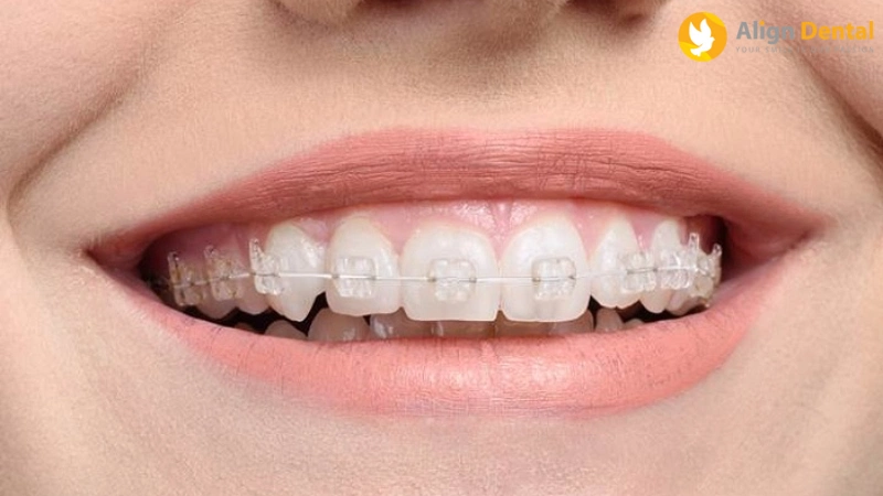 các loại niềng răng