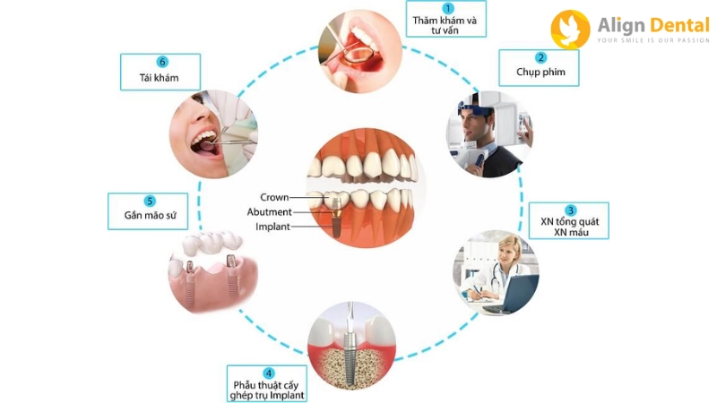 trồng răng implant