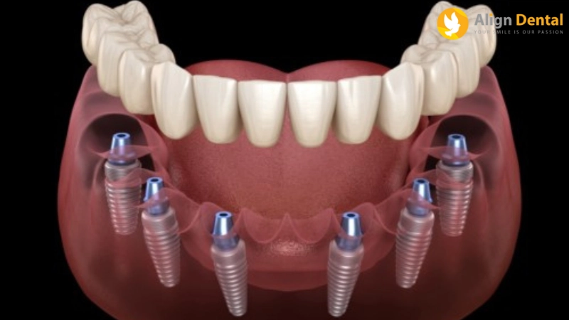 implant toàn hàm